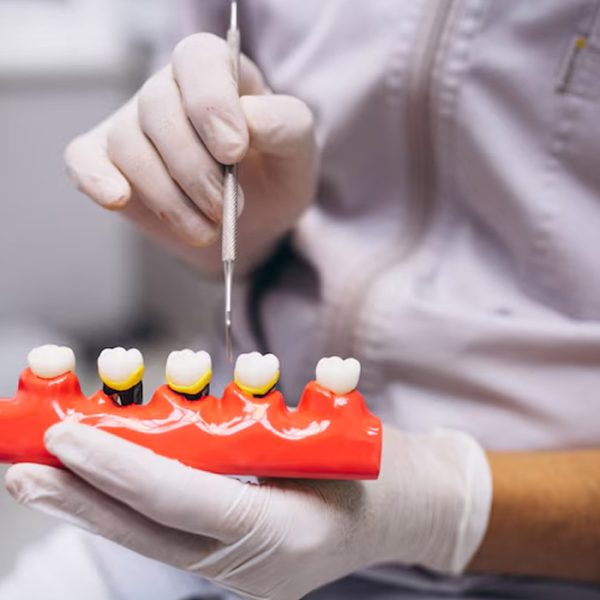 Ceramic Crowns at Angamaly Clinic Prices & Natural Restorations