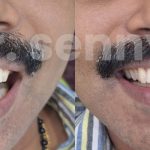 Midline Diastema: Causes, Management, and Treatment Options