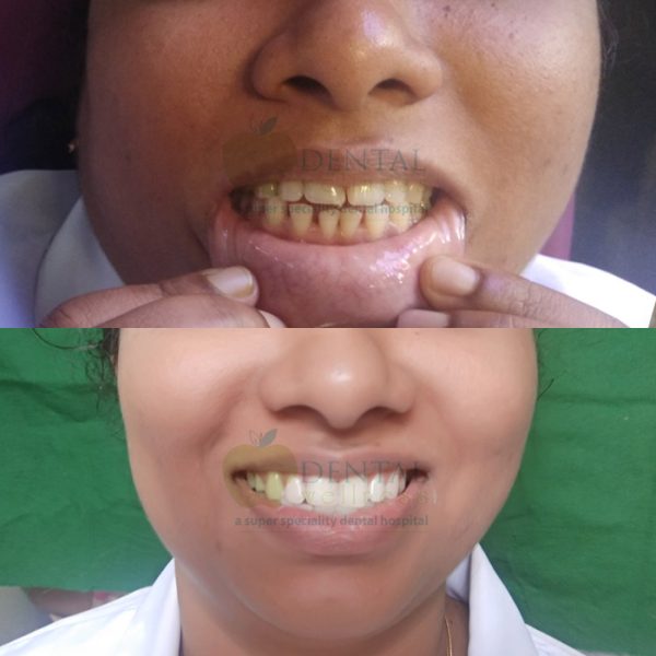 best teeth whitening dental clinic angamaly, Kochi, Ernakulam